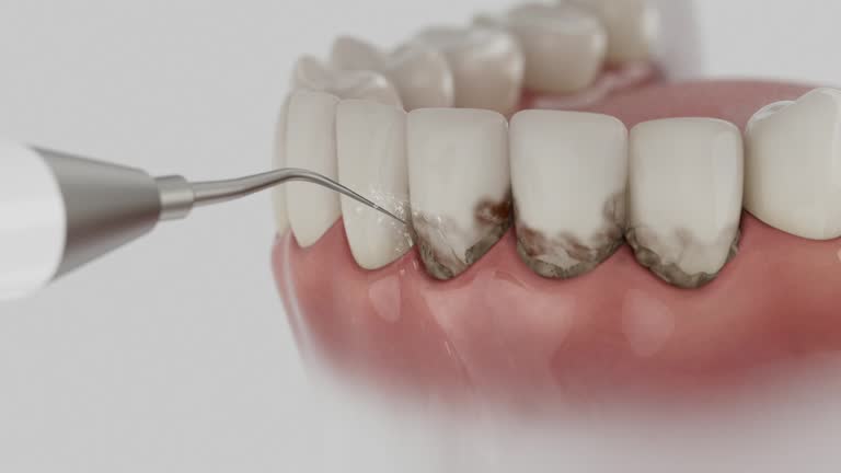 Trusted Wisdom Tooth Removal service in Cedar Springs, MI - Dentist Open Now